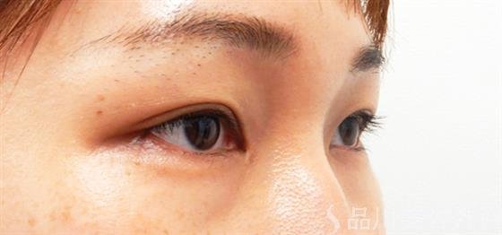 症例NO.53089のAFTER写真
