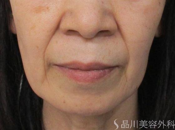 症例NO.52771のBEFORE写真