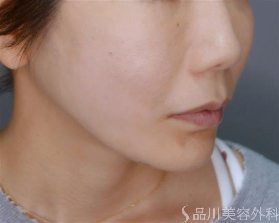 症例NO.51779のAFTER写真