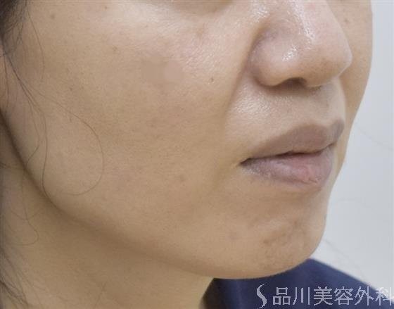 症例NO.51623のBEFORE写真